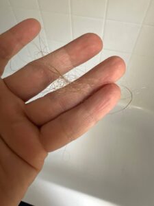 Hairloss